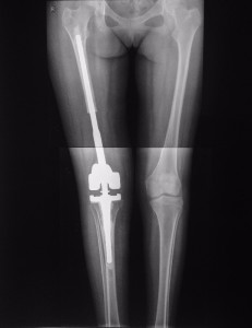 Фронтальный рентгеновский снимок двигательного аппарата пациентки после операции